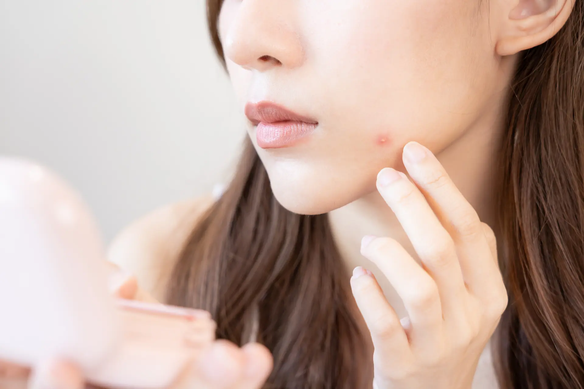 When you want to treat recurring adult acne